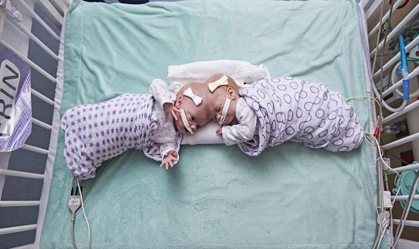 Gêmeas Erin e Abby Delaney no Hospital Infantil da Filadélfia, em setembro de 2016. (Foto: AP)