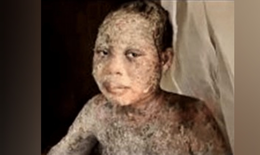 Amina Nagudi, de 13 anos, foi atacada com ácido junto com os pais, por aceitar Jesus, em Uganda. (Foto: Morning Star News).