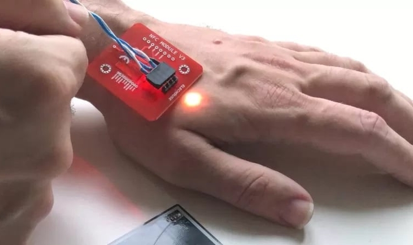Um raio-x mostra um implante Walletmor, que é injetado na mão de uma pessoa após um anestésico local. (Foto: Reprodução / BBC)