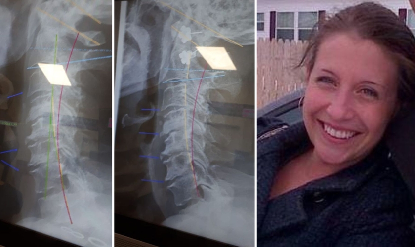 Carol Ann Turko compartilhou o antes e o depois de suas radiografias. (Foto: Reprodução/Facebook Carol Ann Turko))