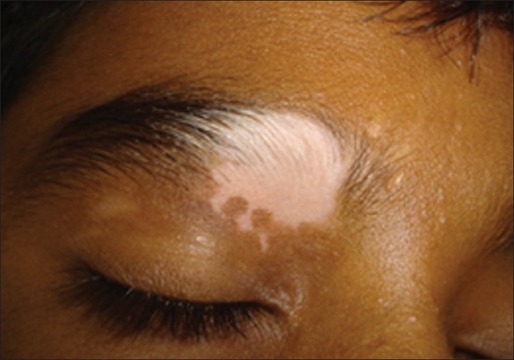 vitiligo 02 vitiligo 02